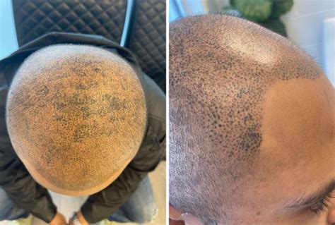 scalp micropigmentation regrets|Scalp Micropigmentation Regrets & How to Prevent .